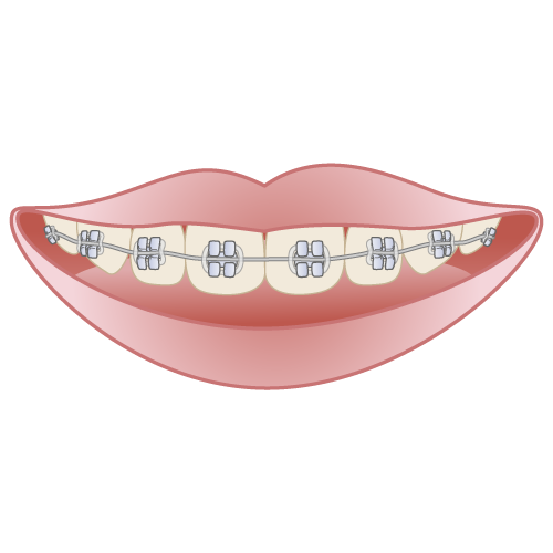 固定式装置である、ブラケットのイメージ画像