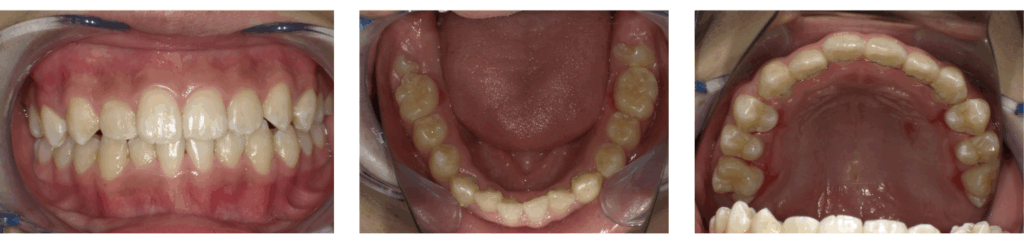 急速拡大装置を使った矯正治療を受けた11歳男の子の治療後の口腔内写真
