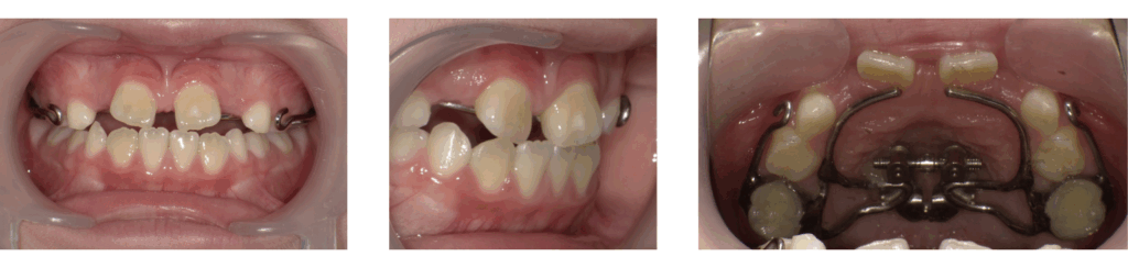 8歳女の子における顎顔面矯正の治療写真