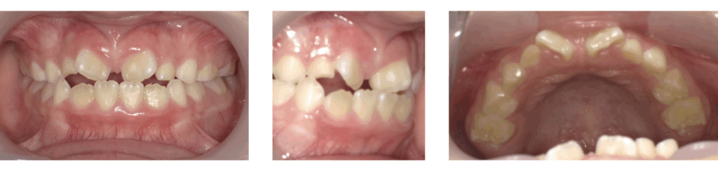 足利市の歯科にて急速拡大装置とブラケット装置を使った矯正治療を受けた8歳女の子の治療前の写真