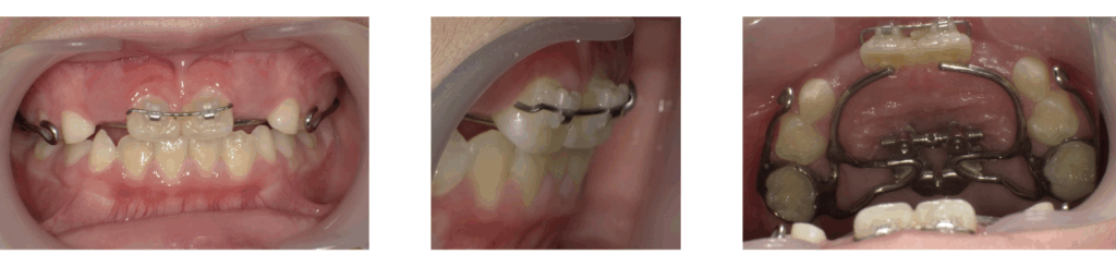 8歳女の子におけるワイヤー矯正の治療写真