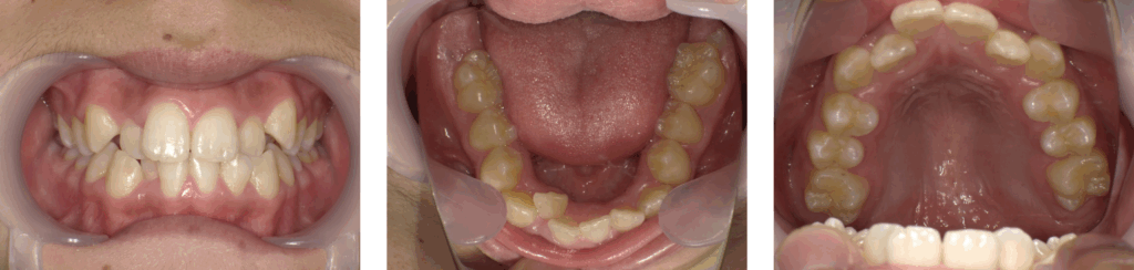 足利市の歯科にて急速拡大装置を使った矯正治療を受けた11歳男の子の治療前の写真