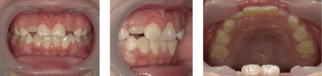 急速拡大装置とブラケット装置を使った矯正治療を受けた8歳女の子の治療後の写真