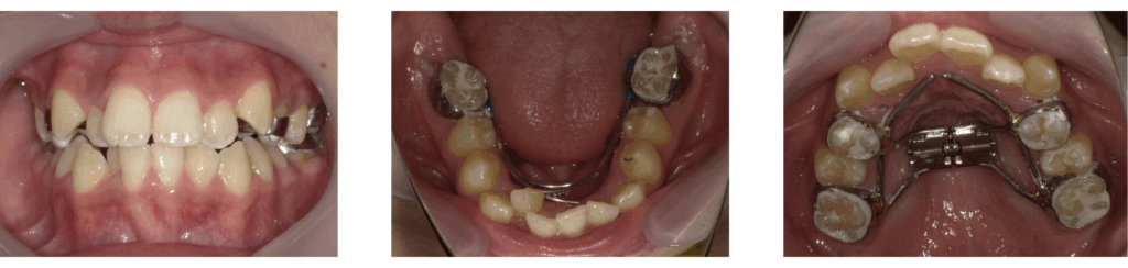 急速拡大装置を装着した状態の11歳男の子の口腔内写真