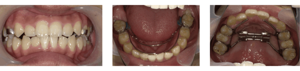 急速拡大装置にて治療を行った11歳男の子の拡大完了後の写真