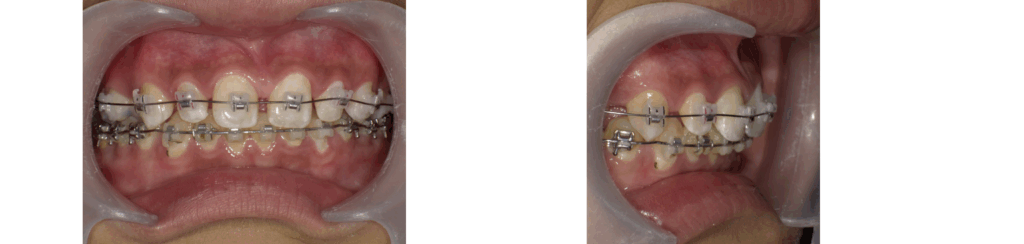 矯正中に虫歯が多発した男の子のワイヤー装着時の写真