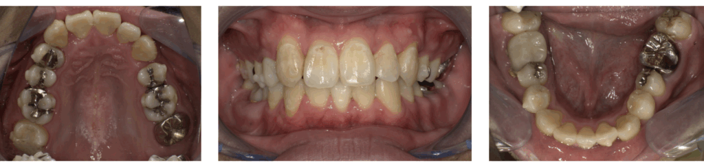 歯科にてマウスピースによる矯正治療を受けた男性の治療後の写真