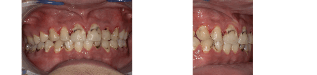 矯正中に虫歯が多発した男の子のワイヤー除去時の写真
