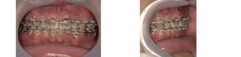 矯正中に虫歯が多発した男の子の症例写真