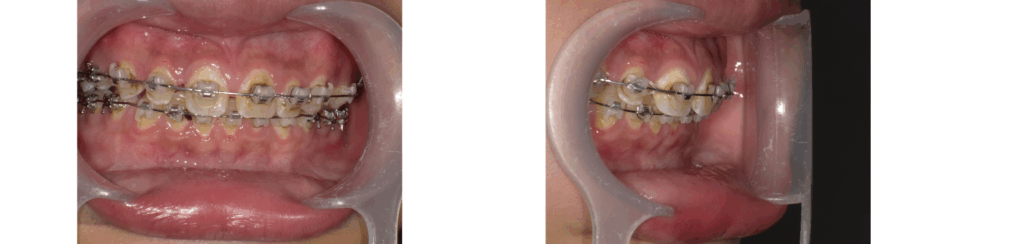 矯正中に虫歯が多発した男の子の虫歯初期の写真