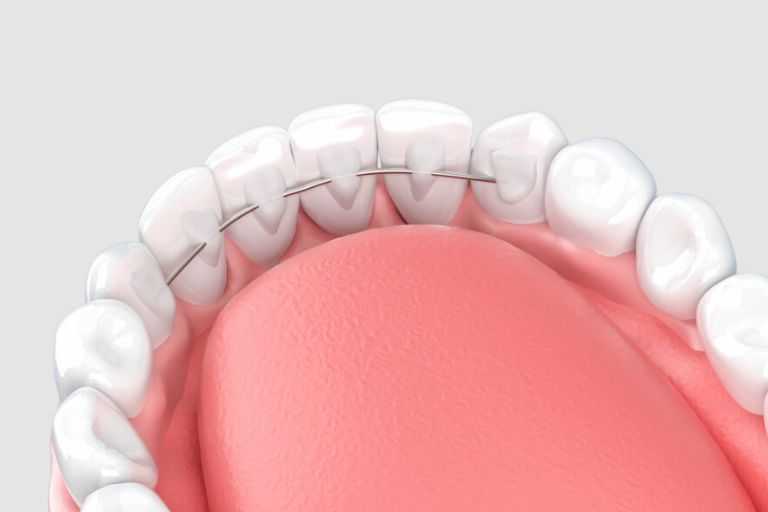 ワイヤー型リテーナーのイメージ画像