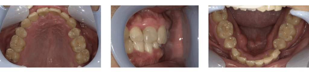 歯科あべクリニックにてマウスピースによる矯正治療を受けた男性の治療後の写真