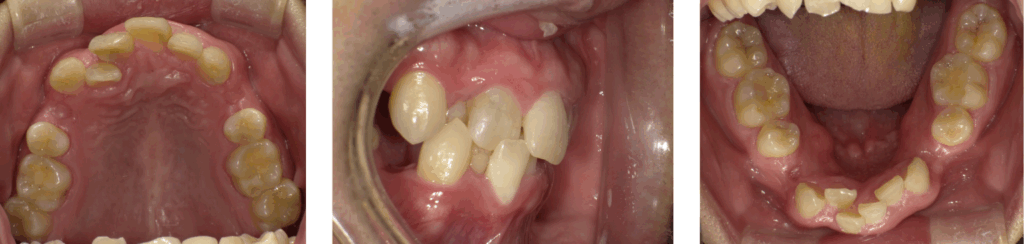 足利市の歯科にてマウスピースによる矯正治療を受けた男性の治療前の写真