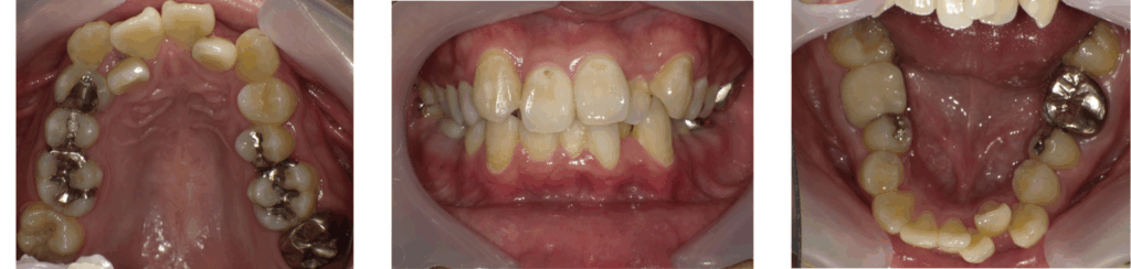 足利市の歯科にてマウスピースによる矯正治療を受けた男性の治療前の写真