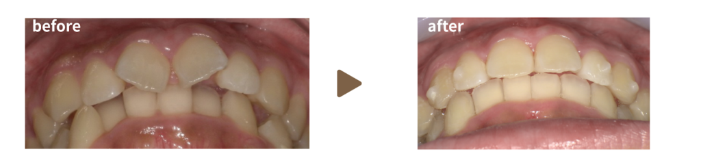 マウスピース矯正を行った女性の下方向から見た治療前後の写真