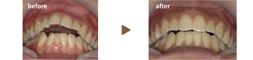 インビザラインで矯正治療を受けた女性の治療前後の下方向からの写真