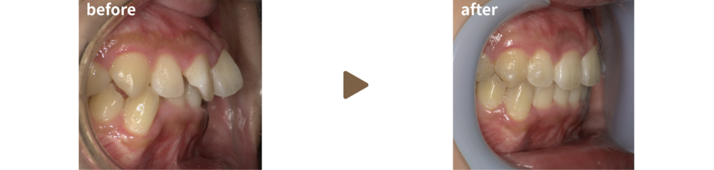 マウスピース矯正を行った女性の横方向から見た治療前後の写真