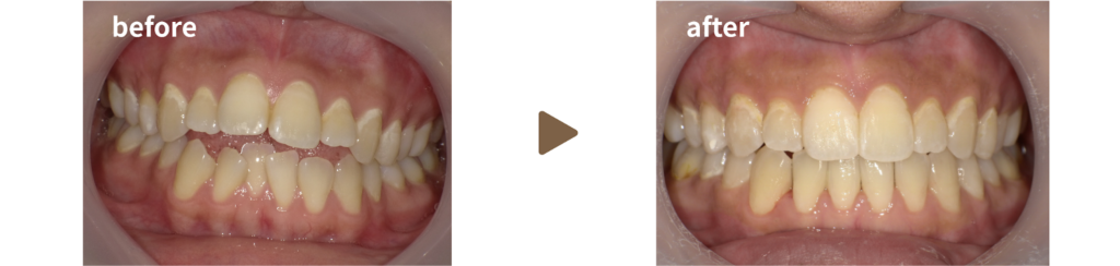 インビザラインで矯正治療を受けた女性の治療前後の正面からの写真