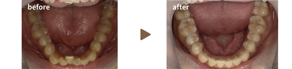インビザラインで矯正治療を受けた女性の治療前後の下あごの写真