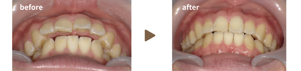 インビザラインによる矯正治療を受けた女性の治療前後の正面の写真
