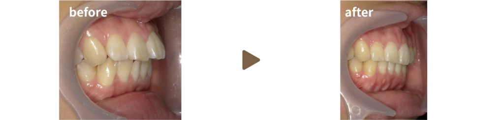 歯科にてマウスピース矯正治療を受けた女性の治療前後の側面の写真