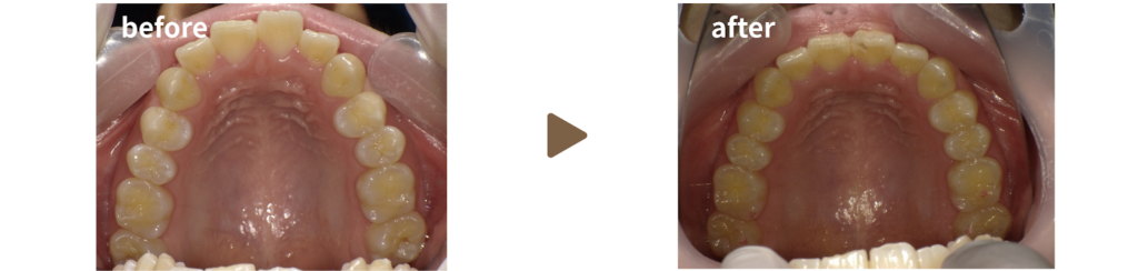 歯科にてマウスピース矯正治療を受けた女性の治療前後の上顎の写真