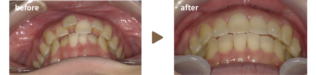 インビザラインによる矯正治療を受けた女性の治療前後の正面の写真