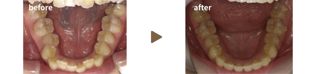 歯科にてマウスピース矯正治療を受けた女性の治療前後の下顎の写真