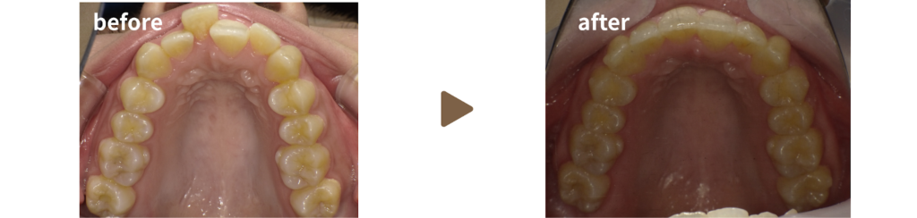 歯科にてマウスピース矯正治療を受けた女性の治療前後の上顎の写真