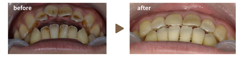 マウスピースによる矯正治療を受けた40代女性の治療前後の下側からの写真