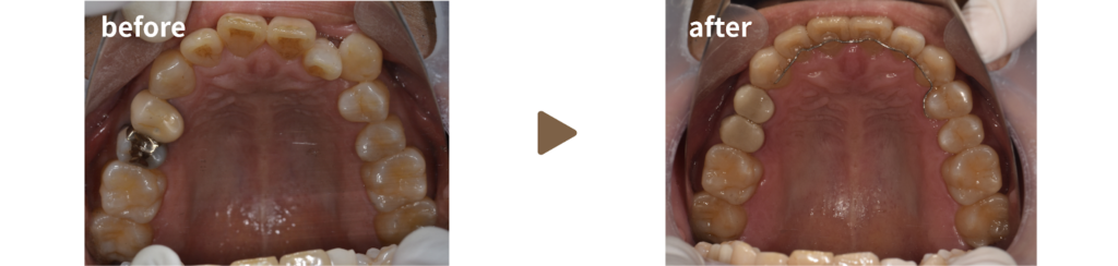 マウスピースによる矯正治療を受けた50代男性の治療前後の上顎の写真