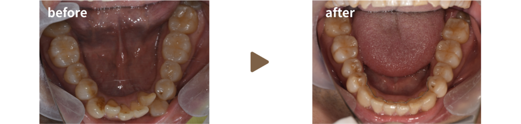 インビザライン(マウスピース矯正)治療を受けた50代男性の治療前後の下顎の写真