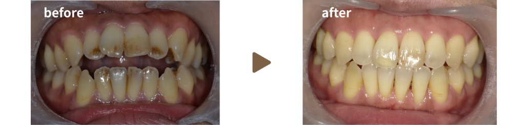 足利市の歯科にてインビザラインによる治療を受けた40代女性の治療前後の正面の写真