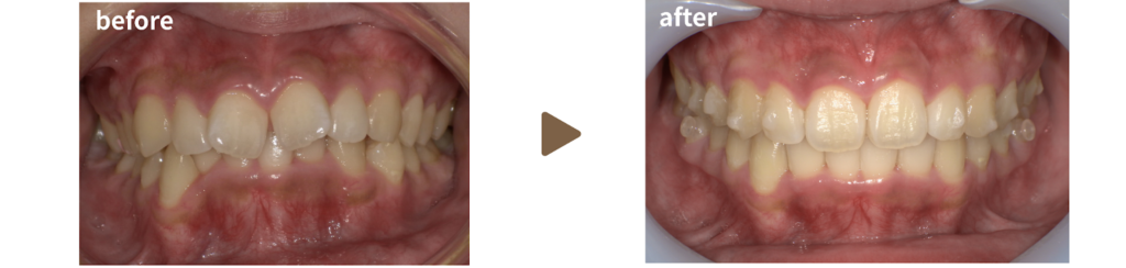 足利市の歯科でマウスピース矯正を行った女性の正面から見た治療前後の写真
