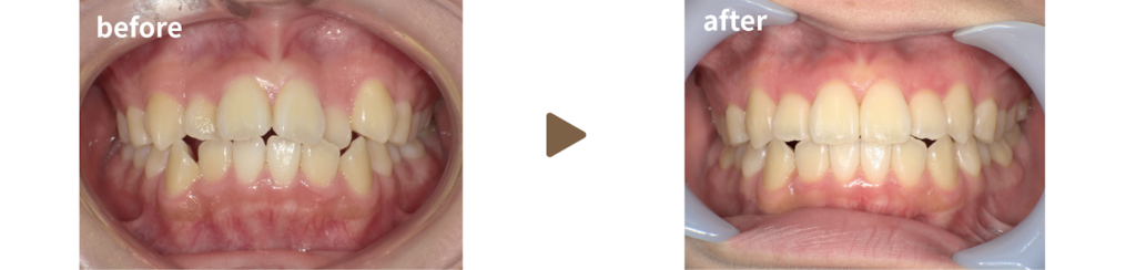 足利市の歯科にて、セラミックブラケット矯正を行った女性の下方向から見た治療前後の写真