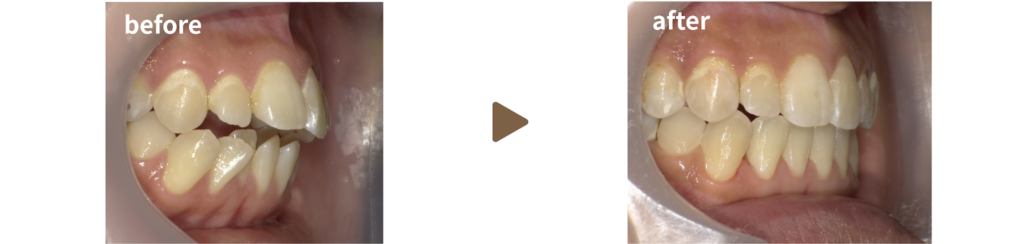 インビザラインで矯正治療を受けた女性の治療前後の側面からの写真