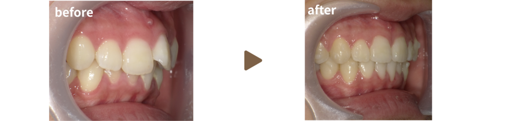 インビザラインによるマウスピース矯正を行った20代女性の治療前後の写真