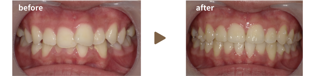 足利市の歯科にてマウスピース矯正を行った20代女性の治療前後の写真