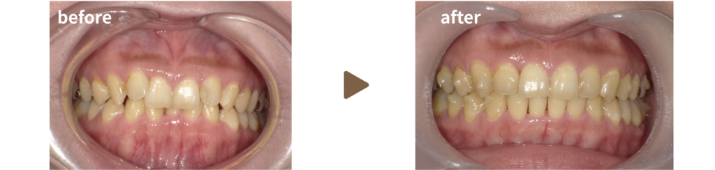 マウスピース矯正を行った20代女性の治療前後の写真