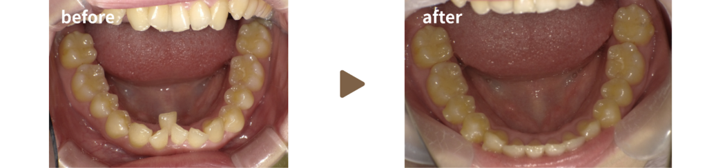 マウスピース矯正を行った20代女性の治療前後の写真