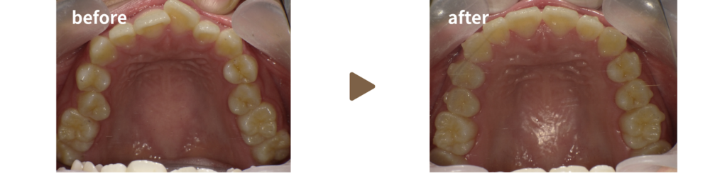 マウスピース矯正を行った20代女性の治療前後の写真