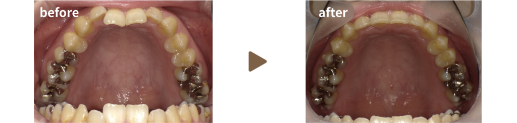 足利市の歯科にてマウスピース矯正を行った20代女性の治療前後の写真
