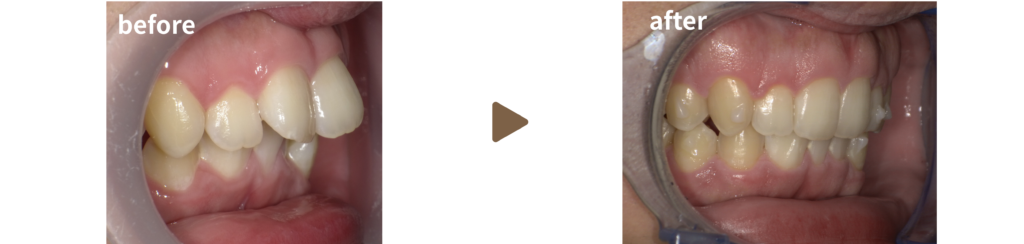 マウスピース治療を受けた30代男性の治療前後の写真