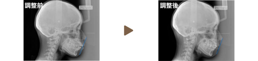 ワイヤー矯正を行った20代女性の調整前後のレントゲン写真