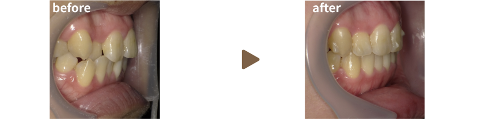 インビザラインで治療を受けた20代女性の治療前後の写真