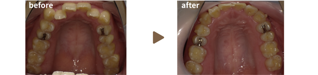 インビザラインで治療を受けた20代女性の治療前後の写真