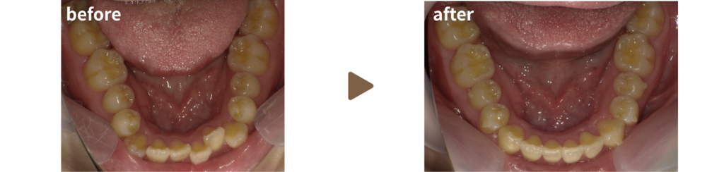 インビザラインで治療を受けた20代女性の治療前後の写真