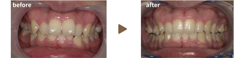 マウスピース治療を受けた30代男性の治療前後の写真