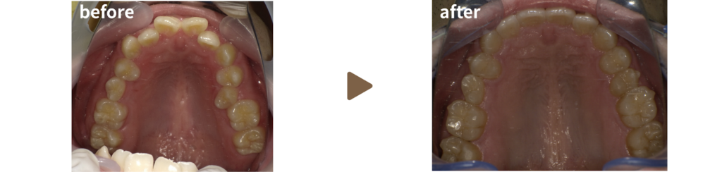 マウスピース治療を受けた30代男性の治療前後の写真