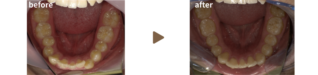 マウスピース治療を受けた30代男性の治療前後の写真